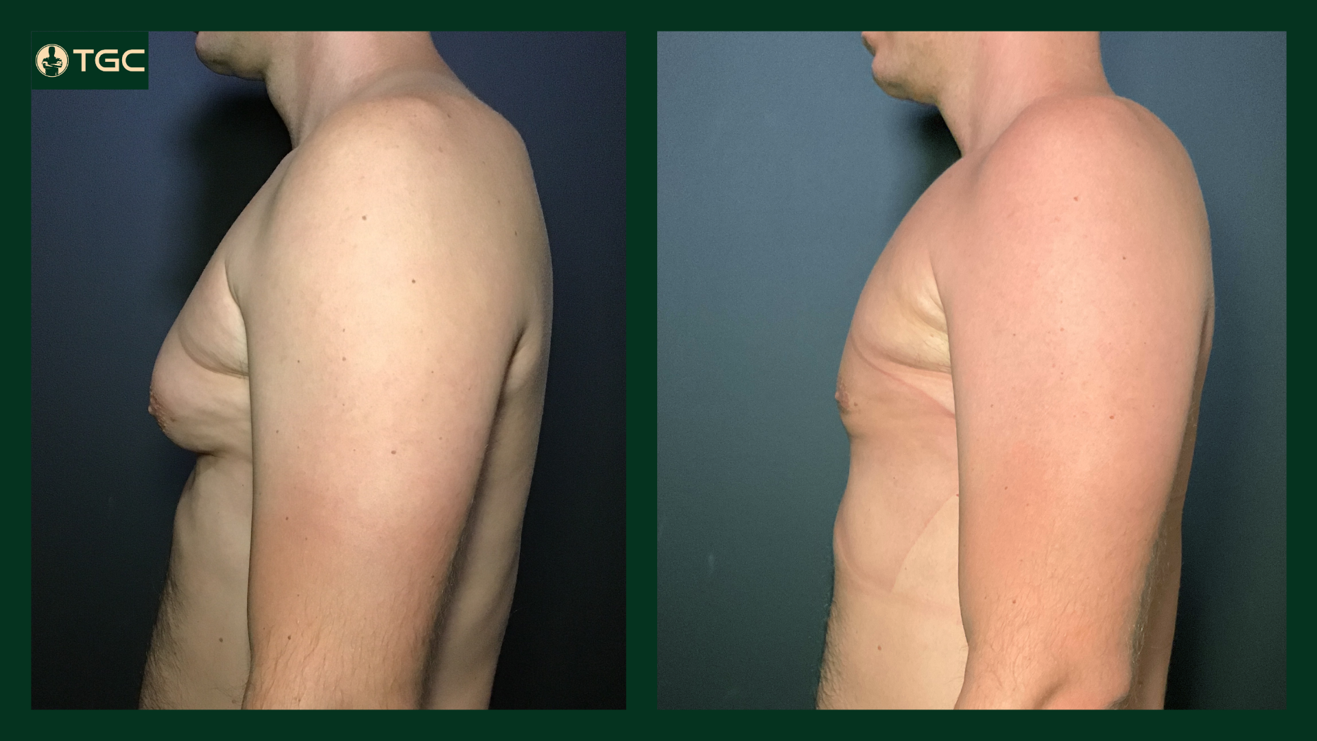 gynecomastia before and after